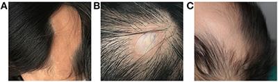 Ophthalmic Manifestation and Pathological Features in a Cohort of Patients With Linear Nevus Sebaceous Syndrome and Encephalocraniocutaneous Lipomatosis